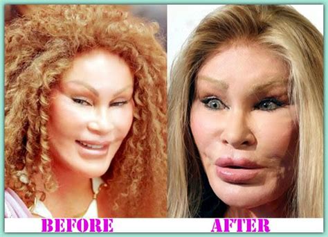 real life catwoman plastic surgery.